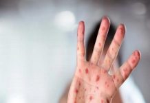 ALERTA: Casos confirmados de sarampión en Argentina; recomendaciones + toda la info