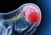 Realizarán una jornada de prevención de la salud cerebrovascular en el Hospital